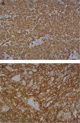 The Interplay Between Programmed Death Ligand 1 and Vimentin in Advanced Non-Small-Cell Lung Cancer